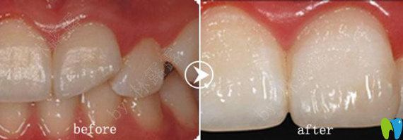 深圳爱康健齿科补牙治疗前后对比图