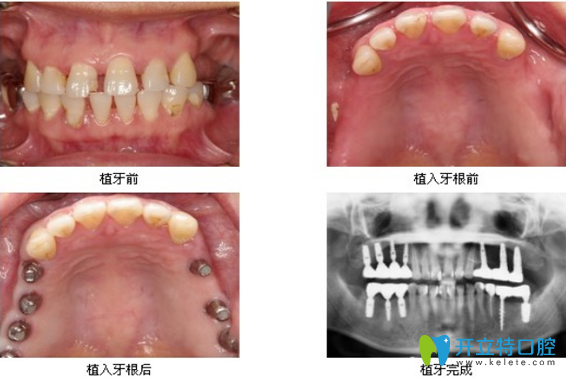 深圳诺德牙齿矫正好吗？激光种植牙案例过程图