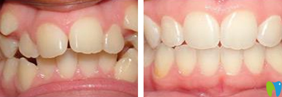 深圳诺德齿科时代天使隐形矫正案例