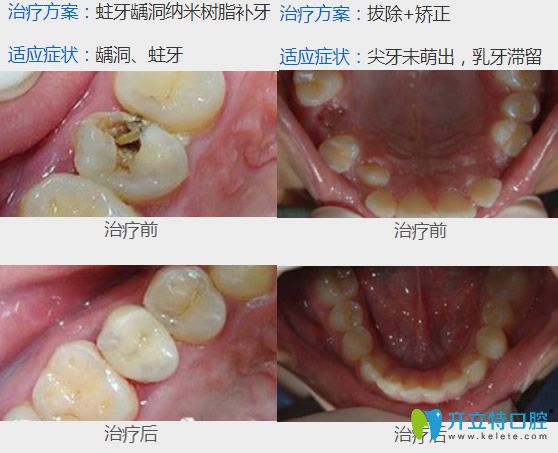 成人口呼吸矫正(3)