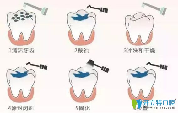 窝沟封闭的操作流程