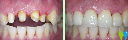 深圳蒙恩齿科烤瓷牙前后对比图