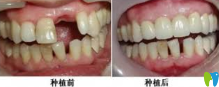 深圳蒙恩齿科即刻种植牙效果对比图