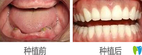 蒙恩齿科黄美华全口牙种植前后效果对比图