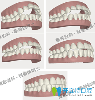 蒙恩齿科程碧焕为我做的隐适美牙齿矫正3D效果图