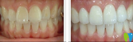 蒙恩齿科冷光牙齿美白前后效果对比图