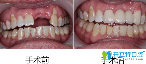 深圳蒙恩齿科黄美华单颗种植牙前后效果对比图