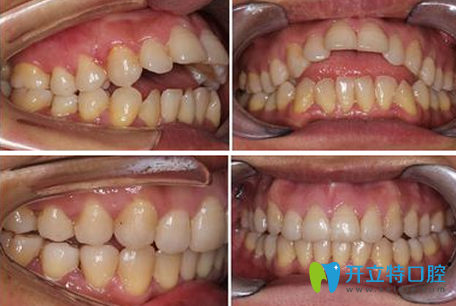 蒙恩齿科隐形牙齿矫正前后效果对比图