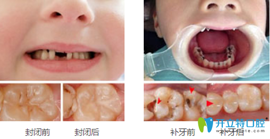 儿童在<!--<i data=20240703-sp></i>-->口腔治疗前后效果对比照片