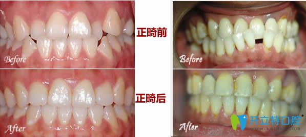 26岁轻微牙齿不齐矫正和28岁反颌且牙齿间隙正畸前后对比照