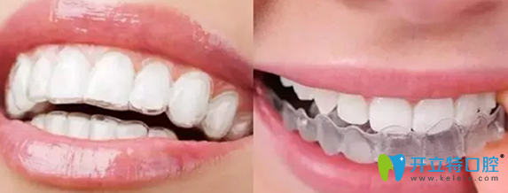 隐形矫正器的价格要多少?透明的牙套真的可以矫正牙齿吗