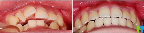 东莞固德口腔28岁牙齿矫正前后对比照