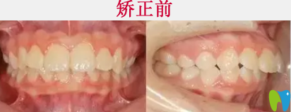 清远中大口腔案例牙齿矫正术前照