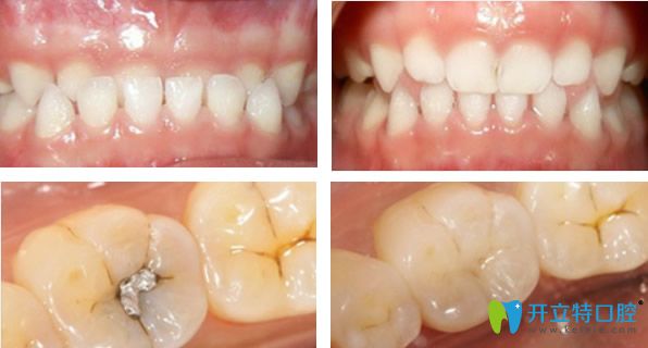深圳龙普兰特口腔小孩乳牙反颌 龋齿补牙效果对比