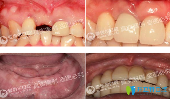 徐安斌单颗牙缺失种植案例+全口牙缺失种植案例