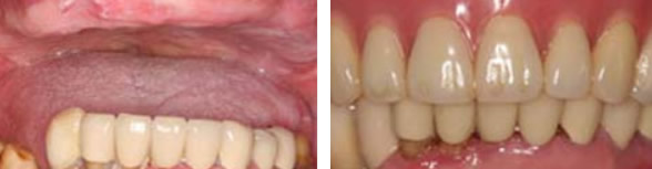 从三张牙齿矫正+种植牙图片 看深圳韦博口腔技术实力怎么样