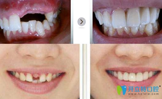 舒斯特牙齿种植案例前后对比照片