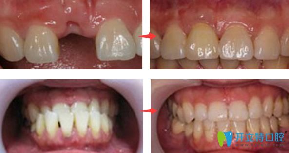 麦芽口腔单颗牙缺失种植+牙齿矫正效果案例