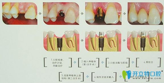 北京科尔口腔种植牙的步骤