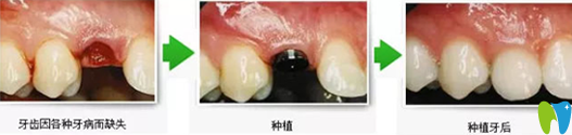 种植牙前后效果对比图