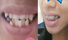 分享我在淮安牙知道口腔花1万多做金属托槽牙齿矫的经历