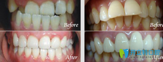 鲁璇牙齿矫正真人案例前后效果对比图