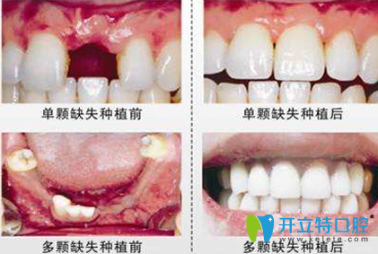 西安美奥口腔种植牙效果对比图