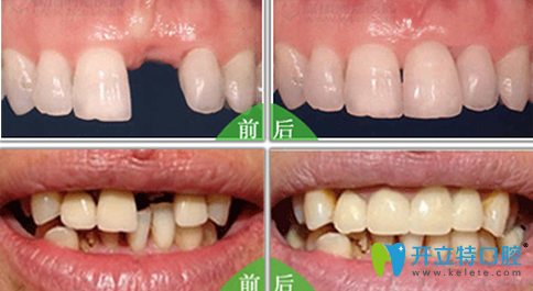 成都瑞泰口腔种植牙效果对比图