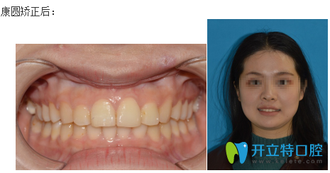 康圆口腔牙齿矫正前后对比图片