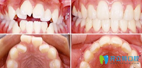 成都瑞泰口腔牙齿矫正前后效果对比图