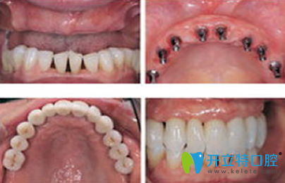 成都瑞泰口腔种植牙前后效果对比图