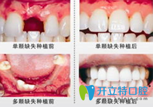 郑州精益口腔李瑞萍院长种植牙前后对比图