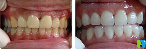 郑州精益口腔牙齿美白前后对比图
