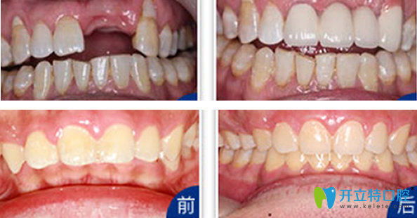 天津拜博口腔种植牙+牙齿矫正效果案例