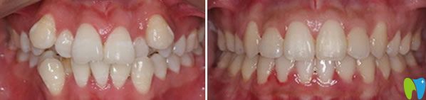 美奥口腔段婷牙齿矫正案例