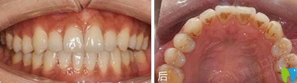 天津拜博口腔隐形矫正18个月后效果