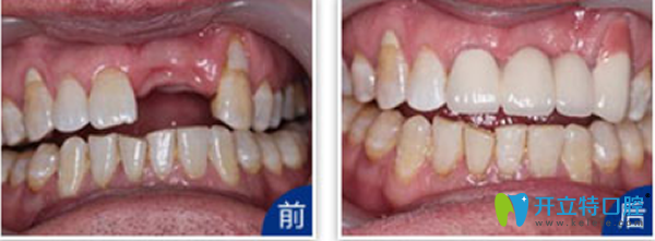 天津拜博口腔门牙缺失种植效果