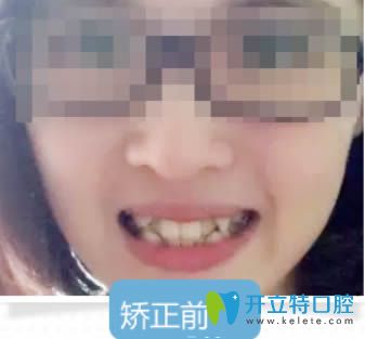 谁说26岁就没必要矫正牙齿了?来看深圳拜尔成年人正畸案例