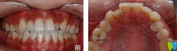 天津拜博口腔隐形矫正牙齿前