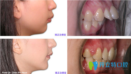 厦门天使口腔龅牙矫正前后对比图