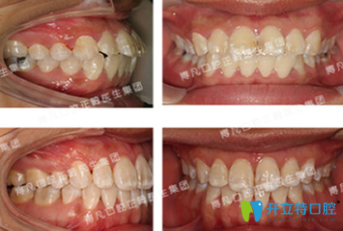 杭州博凡口腔卢海平龅牙矫正前后效果对比图