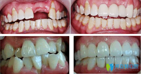 牙祖口腔种植牙+牙齿矫正效果案例