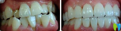 泰州北极星口腔牙齿矫正前后对比图