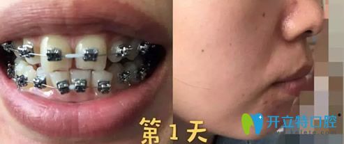 熊洪元做牙齿矫正第1天样子