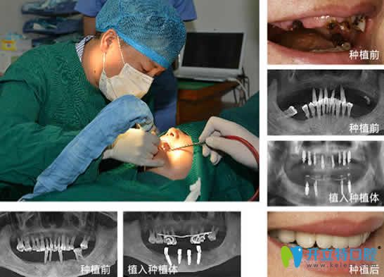 <!--<i data=20240703-sp></i>-->口腔全庆波种植牙案例效果图