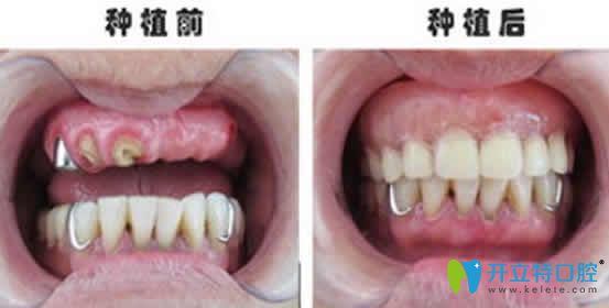 无锡康贝佳口腔种植牙案例效果图