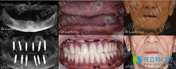 牙博士口腔朴东信院长全口种植牙代表案例