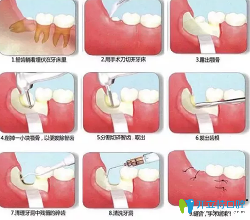 阻生智齿拔出过程图