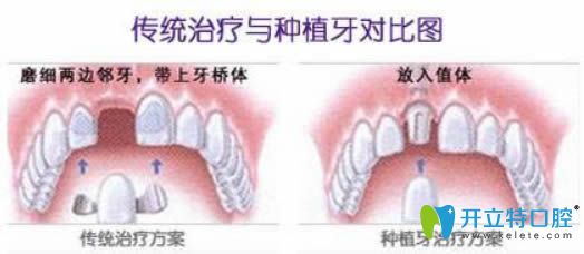 种植牙和镶牙步骤图示