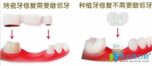 种植牙和镶牙的区别在于前者需要磨牙后者不磨牙